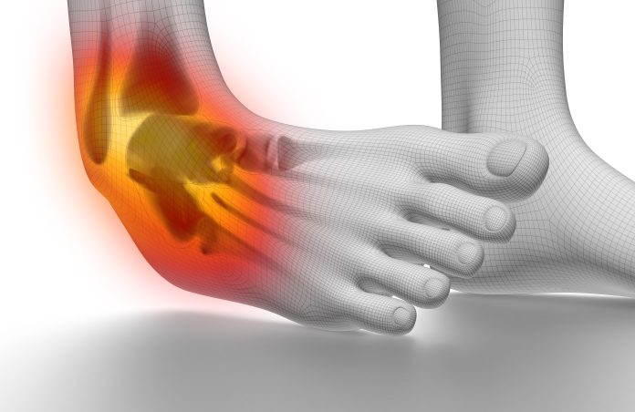 sprained ankle
